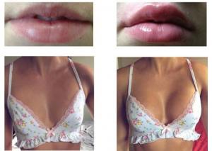 China Breast Enlargement Injection Filler Hyaluronic Acid Implant Lip Injections Dermal Filler wholesale