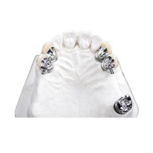 China Easy Clean OEM Precision Attachment Partial Denture Stain Resistant wholesale