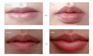 Cross Linked Hyaluronic Acid Filler Injections , Face Wrinkle Filler Eco Friendly