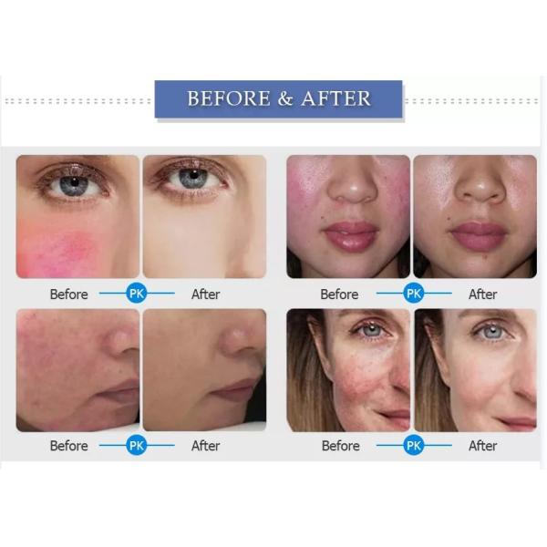 Professional 980nm Diode Laser Machine For Spider Veins / Vascular Removal