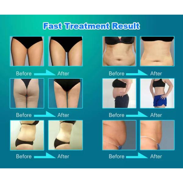 5 In 1 Cavitation RF Slimming Machine , Ultrasonic Anti Cellulite Massager Lose Weight Machine