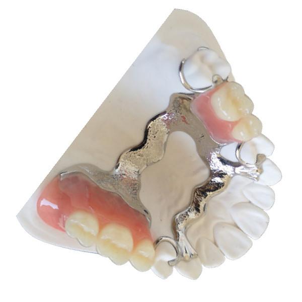 Quality Customized PFM Tooth Crown 3D Printing PFM Dental Bridge for sale