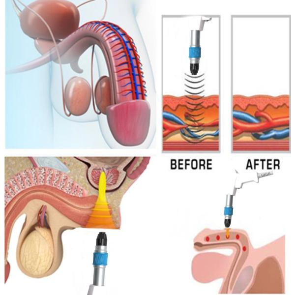 21hz Shock wave Device Intensity Extracorporeal Shockwave Therapy For Plantar Fasciitis Pain Healing