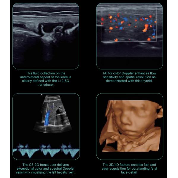 Edan AX4 Laptop 3D/4D Color Doppler Ultrasound scanner