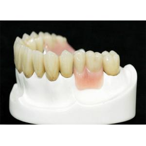 MK1 Precision Attachment Denture for Perfect Fit and Protection