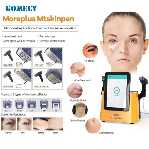 Treatment For Fine Lines Acne Treatment Nasolabial Folds Cervical Stripes Stretch Marks RF Microneedling Machine