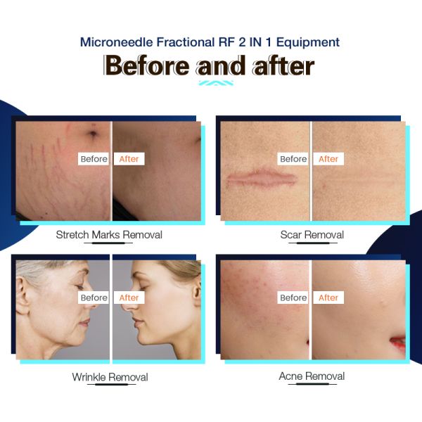 CE FDA Fractional Rf Microneedling Machine Thermage Skin Rejuvenation Wrinkle Removal Face Lift
