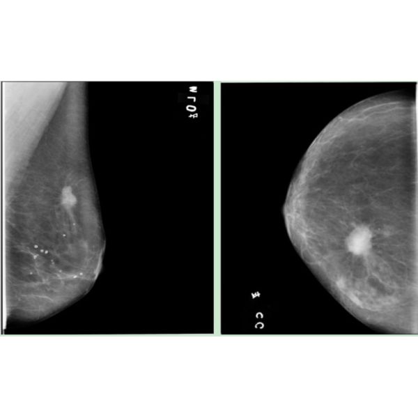 Full Digital Mammography System with Panel Detector for Sales