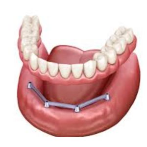 China Screw Retained Translucency Implant Bar Denture Polished Surface Implant Bar wholesale