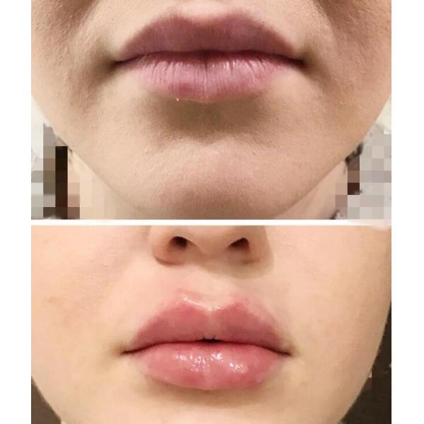 Liporase Inject 1ml Fat Dissolving Injections Belly Dissolve Hyaluronic Acid 10vials/Box