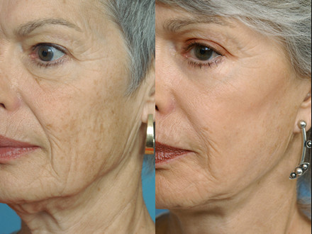 Fractional Co2 Laser Treatment Machine For Epidermis Resurfacing / Wrinkle Reduction