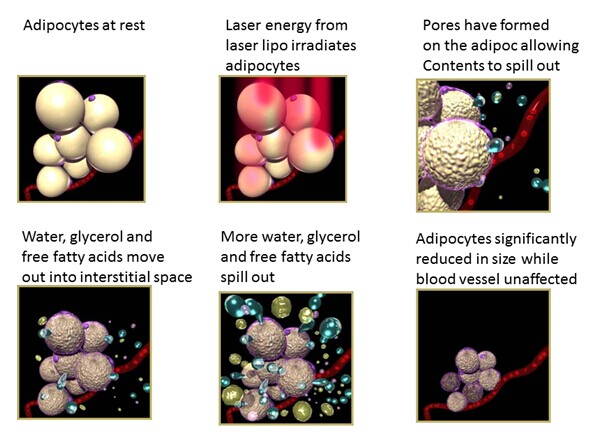 12 Pads 336 Diodes Laser Therapy Machine Portable Lipolaser Body Slimming Machine