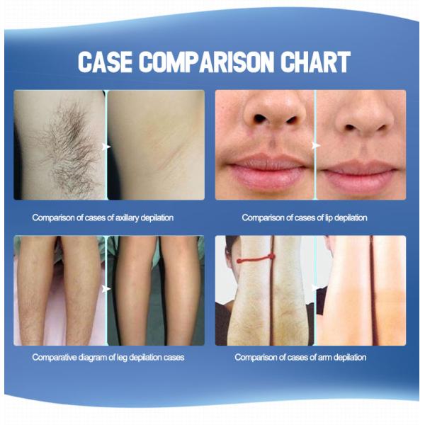 Triple Wave Diode Laser Hair Removal Permanent 10-400ms Pulse Duration 1-10Hz