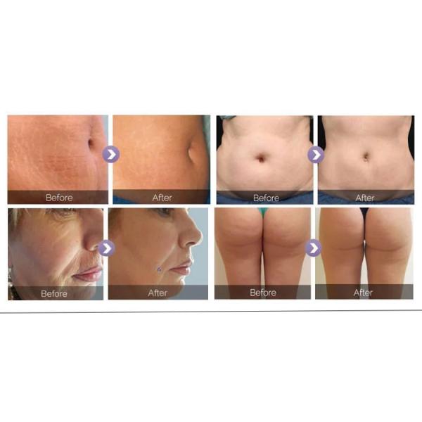 5in1 Lasertell Cavitation Rf Vacuum Body Machine