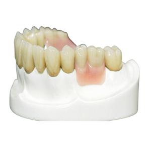 China MK1 Precision Attachment Denture for Perfect Fit and Protection wholesale
