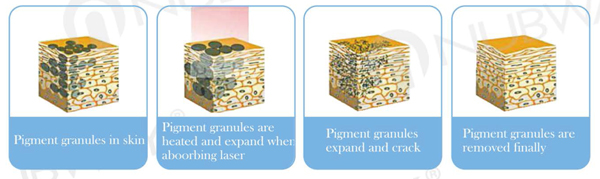 12 years experience Orgin Factory Best 1064nm/532nm lips yag tattoo removal machine