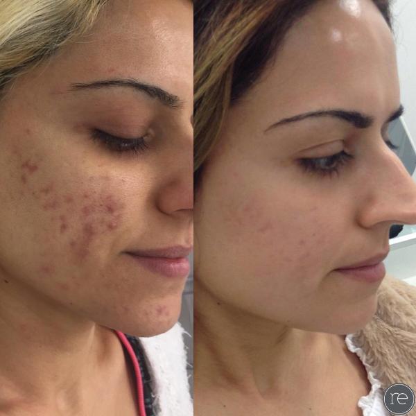 5Mhz Scar Removal Face Lifting Microneedle RF Machine