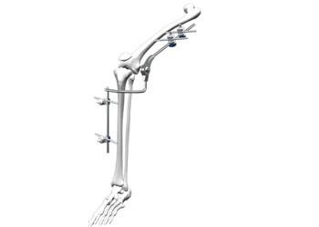 Quality Universal Orthopedic External Fixator Sliver / Blue Color Fit Knee Joint for sale