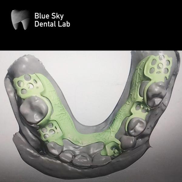 Removable Partial Denture Metal Framework Partial Denture Framework Design