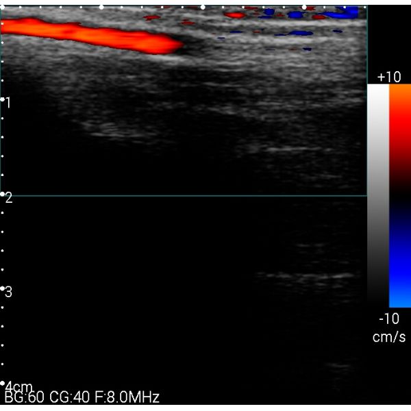Mini Color Doppler Handheld Sonogram Device With 128 Elements 1280*720 Resolution