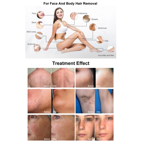 Diode Laser Hair Removal 4 Wavelength 808nm 1064nm 790nn 940nm Permanent Hair Removal By Laser Machine