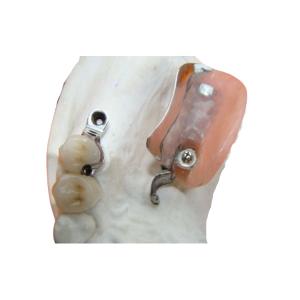 China Dental Lab Long Lasting Precision Attachment Denture Stain Resistant wholesale