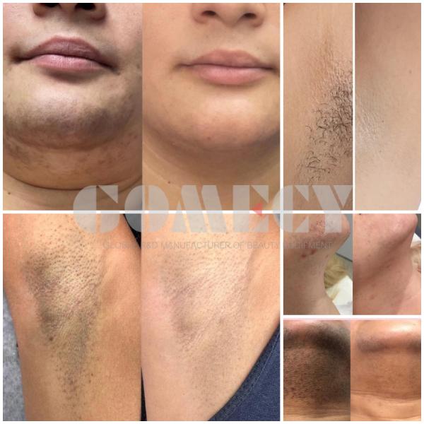 1-200J/Cm2 Diode Laser Machine 1064nm 940nm with Water / Air Energy Density Cooling System