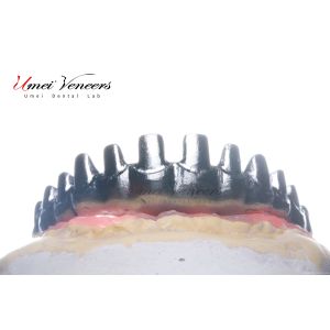 Robust Zirconia Malo Bridge