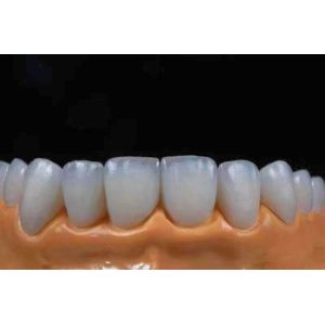 Highly Translucent Esthetic Zirconia Crowns Precise Fit with Natural Looking