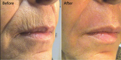 Fractional Co2 Laser Treatment Machine For Epidermis Resurfacing / Wrinkle Reduction