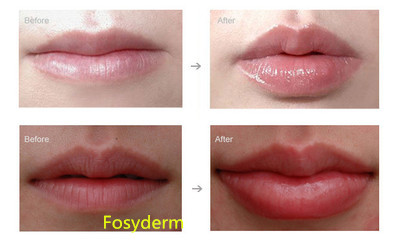 HA Injectable 1ml Cross Linked Dermal Filler For Nose / Lip / Chin / Cheek