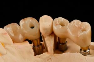 China Self Tapping 3.0mm Thread Dental Titanium Implant Optimized Functionality wholesale