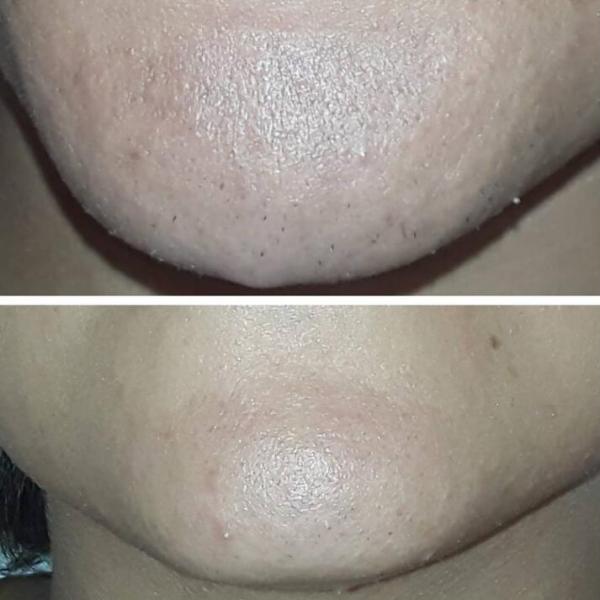 Commercial Portable Diode Laser Machine 808nm 755nm 1064nm 560D Laser Depilator