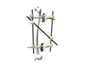 Femur Spanning Orthopedic External Fixator Apply To Fracture Treatment