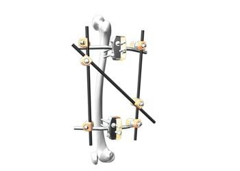 Quality Femur Spanning Orthopedic External Fixator Apply To Fracture Treatment for sale