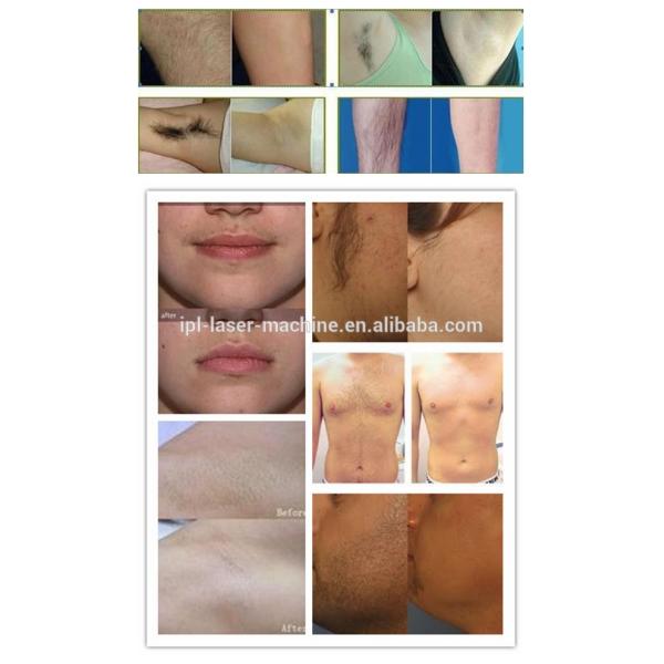 Permanent diode laser hair removal machine for Spa or Salon use