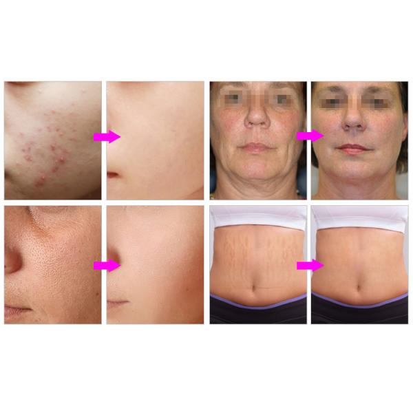 Portable RF Radio Frequency Machine Microneedling Fractional Stretch Marks Wrinkle Removal