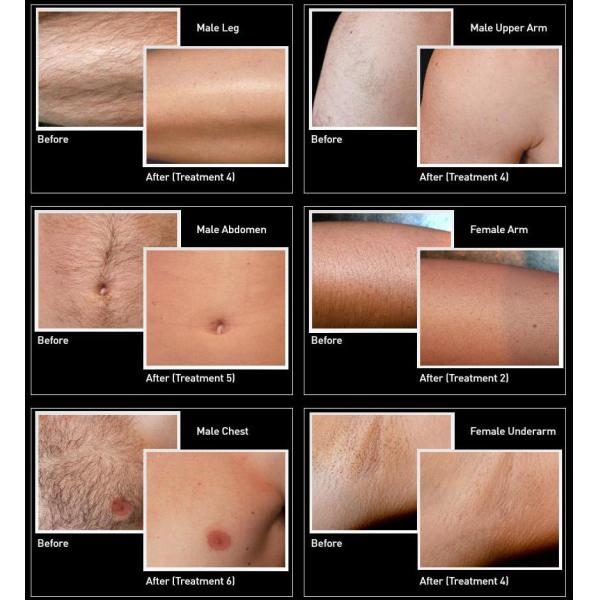 12*24mm2 12*28mm2 Diode Laser Machine 1200W 1600W Laser Hair Removal Machine Professional