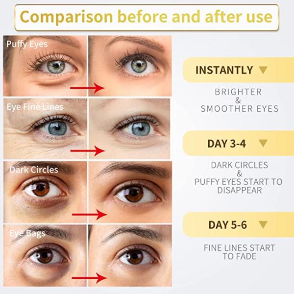 Hyamely Removing Dark Circles Injection Filling Tear Troughs 1ml