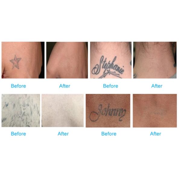 Laser tattoo removal q-switched nd:yag laser carbon peel/Q switched nd yag laser /tattoo removal beauty machine