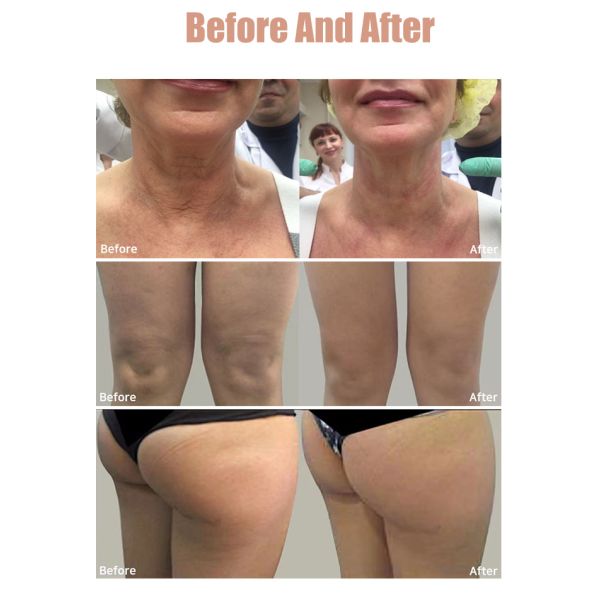 MFU RF Ultrasonic Hifu Beauty Machine For Face Lifting Skin Tightening Wrinkle Reduction Body Firming Treatment