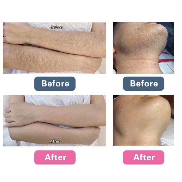 Facial Rejuvenation Picosecond Laser Machine 1064nm 532nm 755nm Wavelength