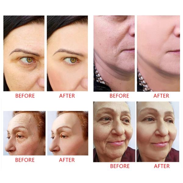 Deep Fine Neck Wrinkles Revolax Hyaluronic Acid Korea Dermal Filler For Forehead Lines