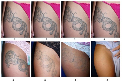 1064 nm ND YAG Laser Machine