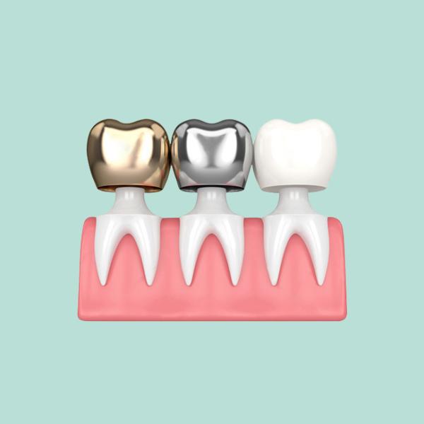 Good Biocompatibility Dental Crowns And Bridges Not Easy To Wear Color Stable
