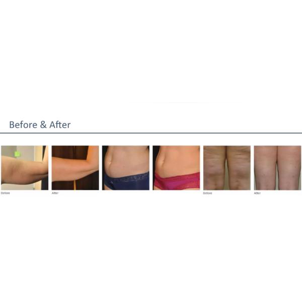 5in1 Lasertell Cavitation Rf Vacuum Body Machine