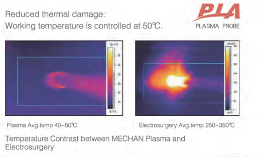 Mechan New Generation of Plasma Generator for Minimally Invasive ENT Surgery -Turbinate Channeling and Ablation
