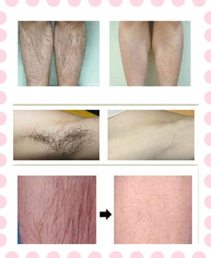 808nm Diode Laser Hair Removal Machine With 12*12mm Spot Size For Depilation