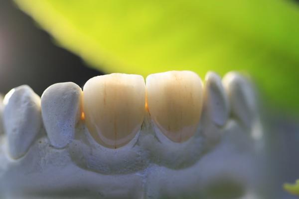 Quality All Ceramic EMAX Porcelain Crown for sale