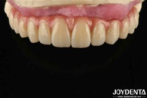 China Comfortable Wear Titanium Malong Hybrid Bridge Dental Adjustable Design Light Weight wholesale